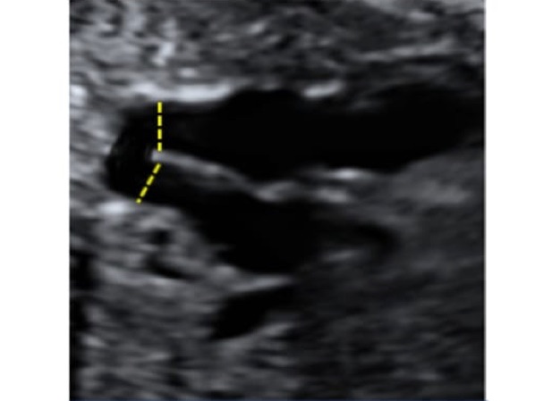 aorta_dimensions_2_ultrasound