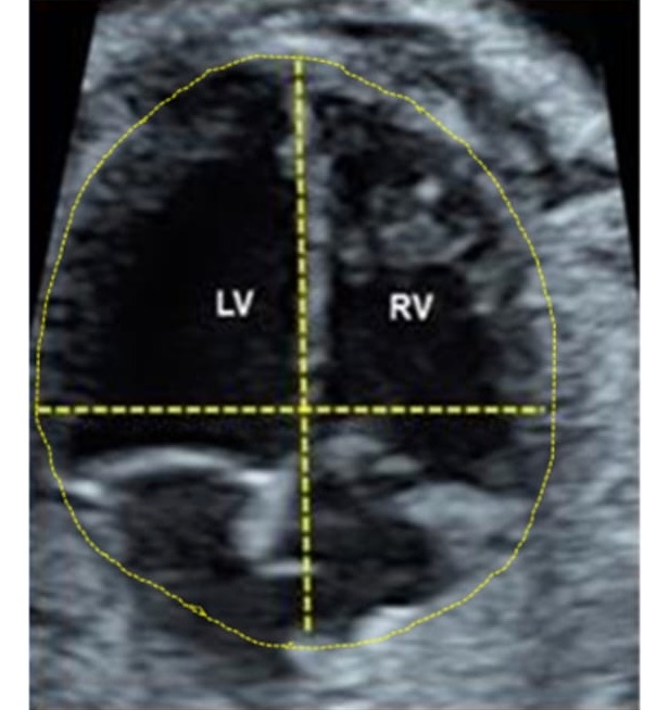 cardiac_dimensions_ultrasound