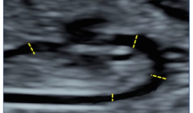 aorta_dimensions_1_ultrasound