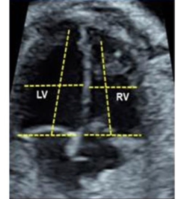 ventricular_dimensions_ultrasound